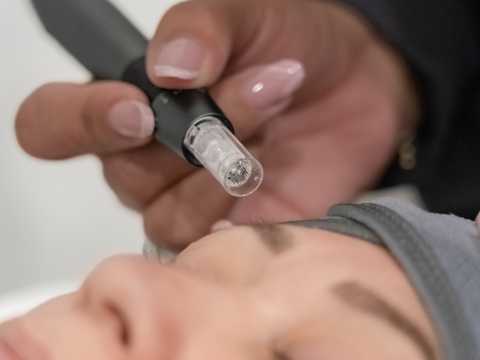 Microneedling Skin Rejuvenation