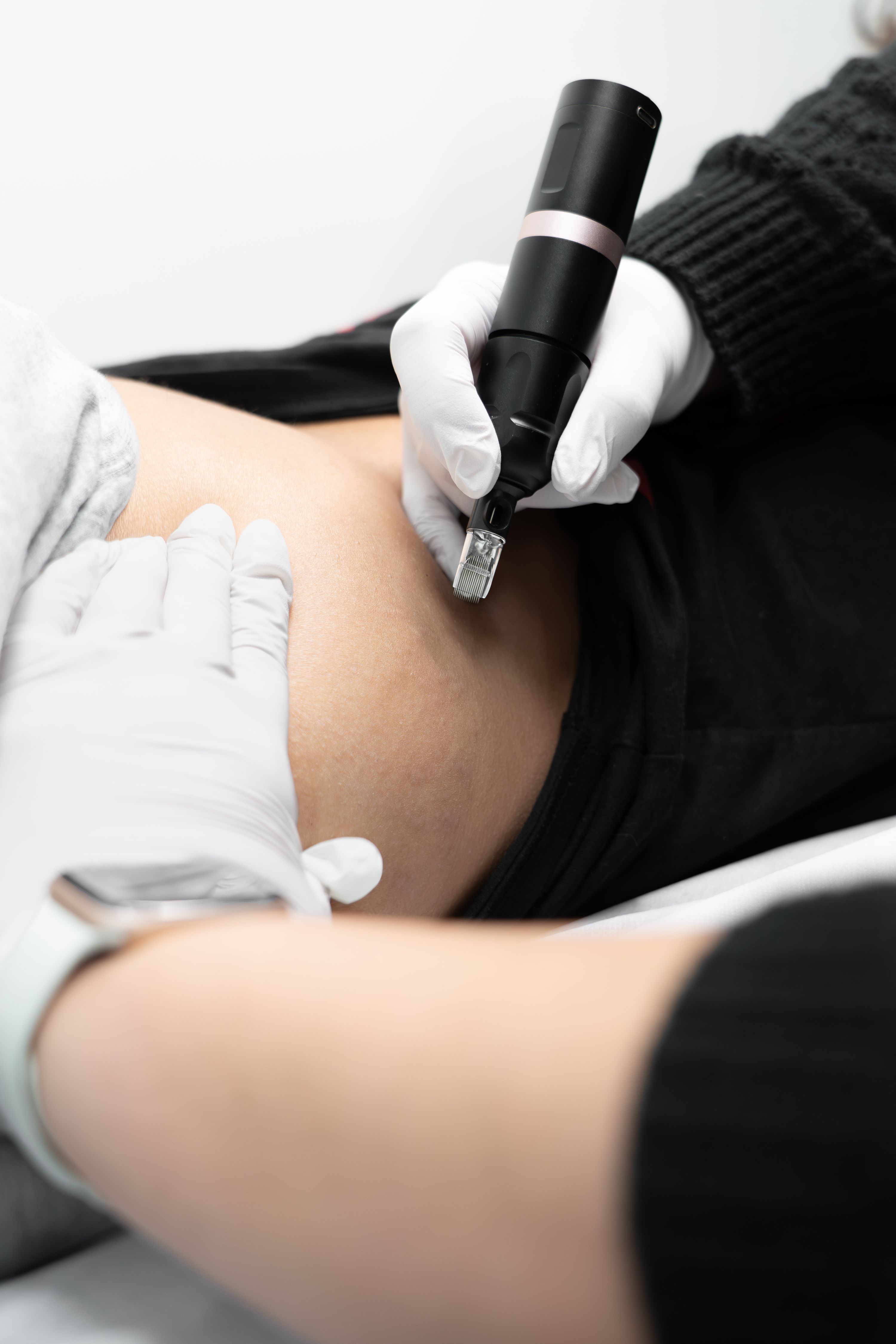 Stretch Mark Removal