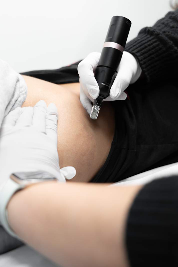 Stretch Mark Removal