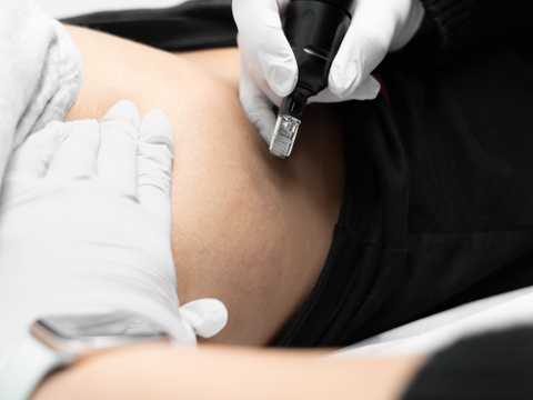 Stretch Mark Removal